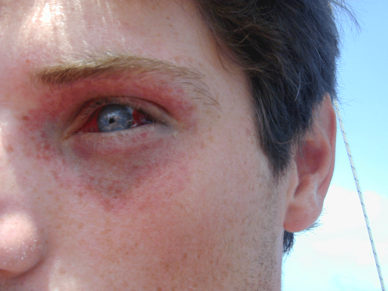 Травма глаза как выглядит