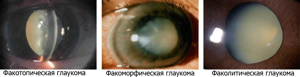 Какая бывает факогенная глаукома