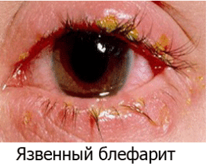 Как выглядит глаз при язвенном блефарите