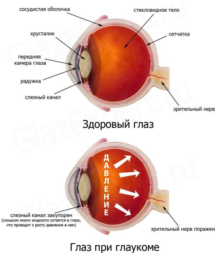 Здоровый глаз и глаз при глаукоме