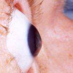 Как выглядит кератоконус глаза