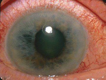 Как выглядит закрытоугольная глаукома
