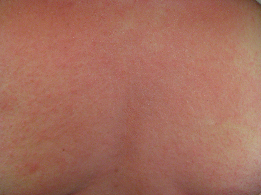 Участок кожи с аллергией