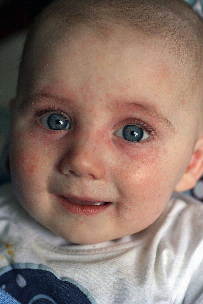 Сыпь на глазах у ребёнка