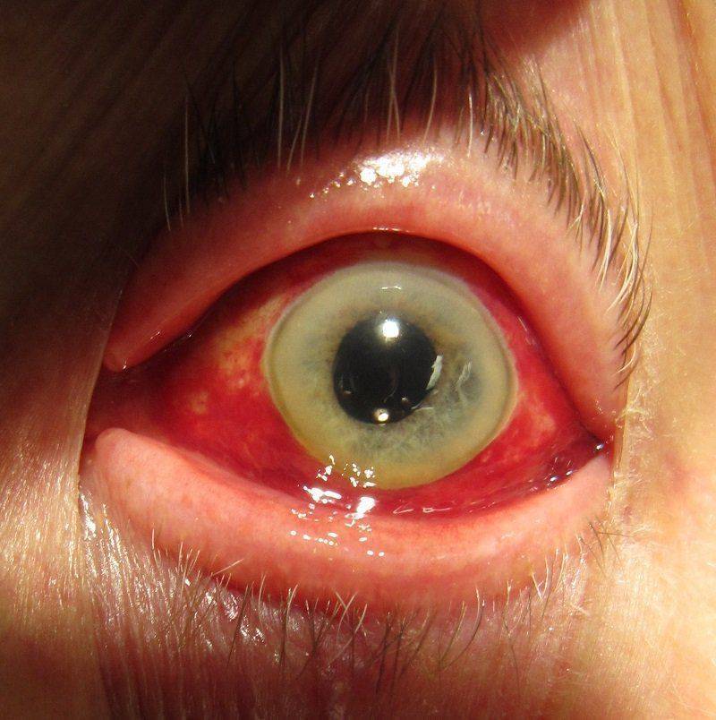 Как выглядит кровоизлияние в глазу