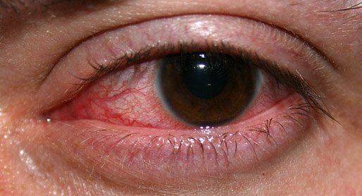 Глазной кератит