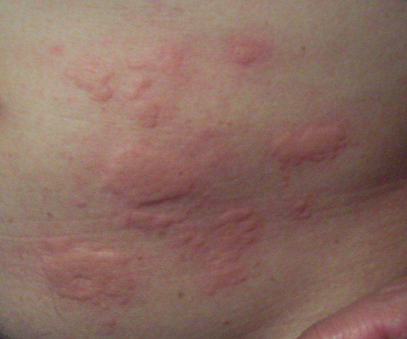 Высыпания на коже (аллергия)