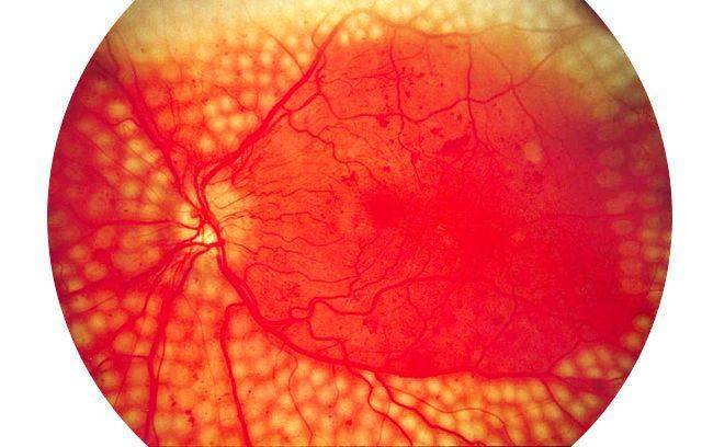 Что такое ретинопатия