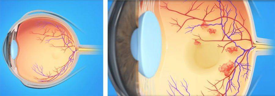 Тромбоз глаза лечение медикаментозно thumbnail