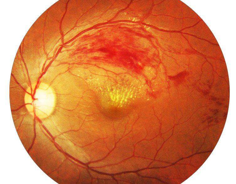 Тромбоз глаза лечение лазером thumbnail
