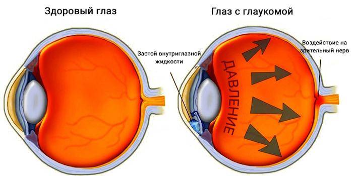 Болит глаз изнутри: причины, симптомы, что делать, как лечить боль внутри века