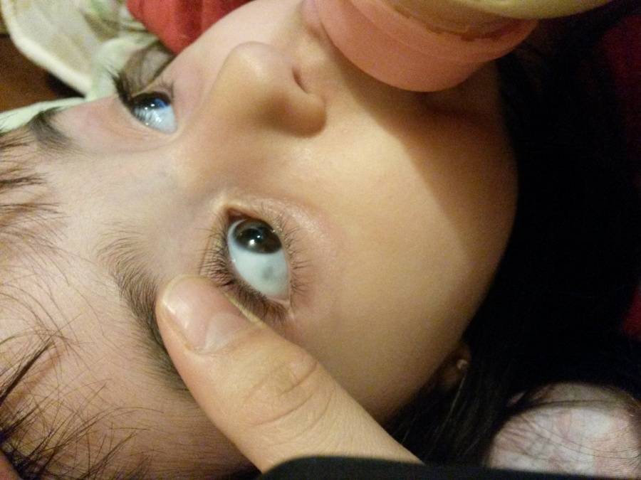 Пятно на роговице глаза у человека: особенности, причины возникновения, виды, симптомы, диагностика и лечение