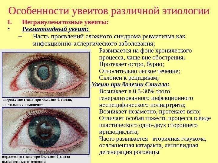 Список заболеваний глаз, их симптомы и лечение