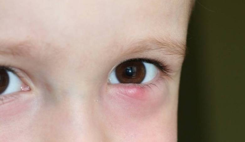 Ячмень на глазу у ребенка: полный список средств и способов лечения