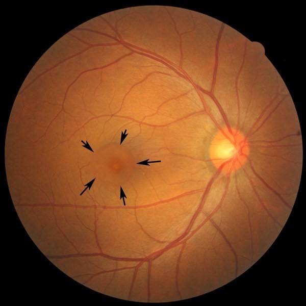 Центральная серозная хориоретинопатия: лечение цсх глаза