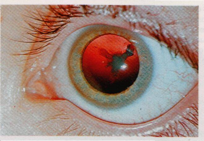 Артифакия правого, левого или обоих глаз: что это такое и как проводится процедура по восстановлению зрения, показания и противопоказания, преимущества метода и возможные осложнения