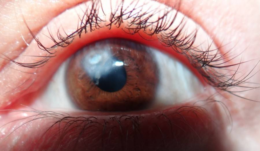 Помутнение в глазах: причины и методы лечения - "здоровое око"