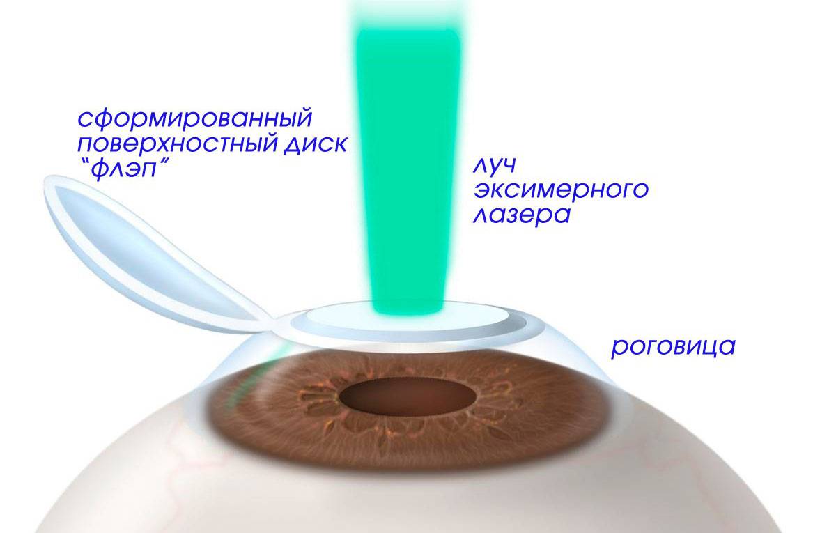 Лазерная коррекция астигматизма: лечение зрения через операцию