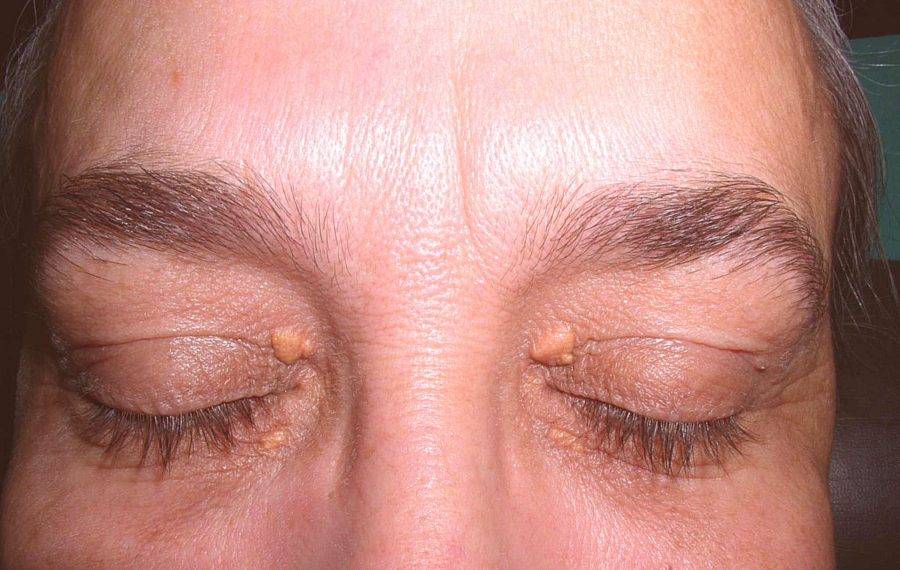 Халязион верхнего века - причины, симптомы (фото), лечение на глазу