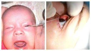 Как и для чего выполняется процедура зондирования слезного канала у новорожденных детей