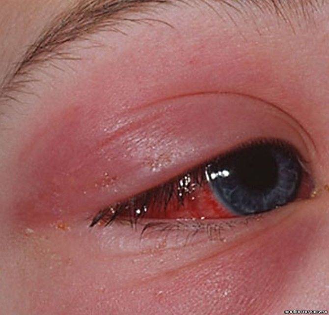 Заболевания кожи вокруг глаз и век. диагностика и лечение