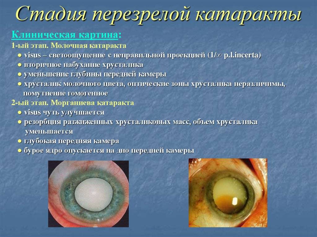 Старческая катаракта (сенильная, возрастная): причины, симптомы, лечение в пожилом возрасте (бесплатное удаление, питание), диагностика, профилактика