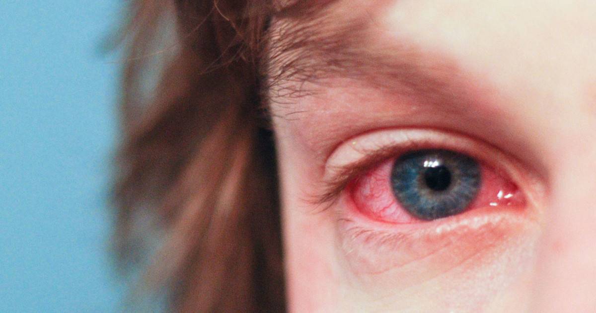 Светобоязнь глаз причины у детей. при каких заболеваниях возникает светобоязнь? лечение и профилактика