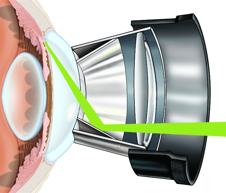 Лазерная иридэктомия (иридотомия): лечение глаукомы лазером, хирургическим методом, а также трабекулопластика