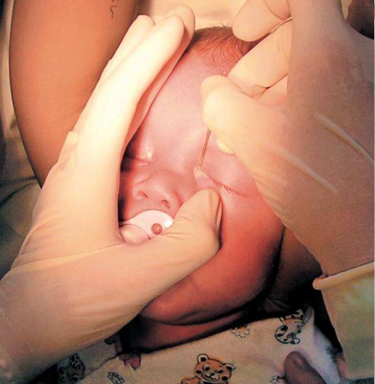 Дакриоцистит у новорожденных, зондирование: как проходит операция, её последствия