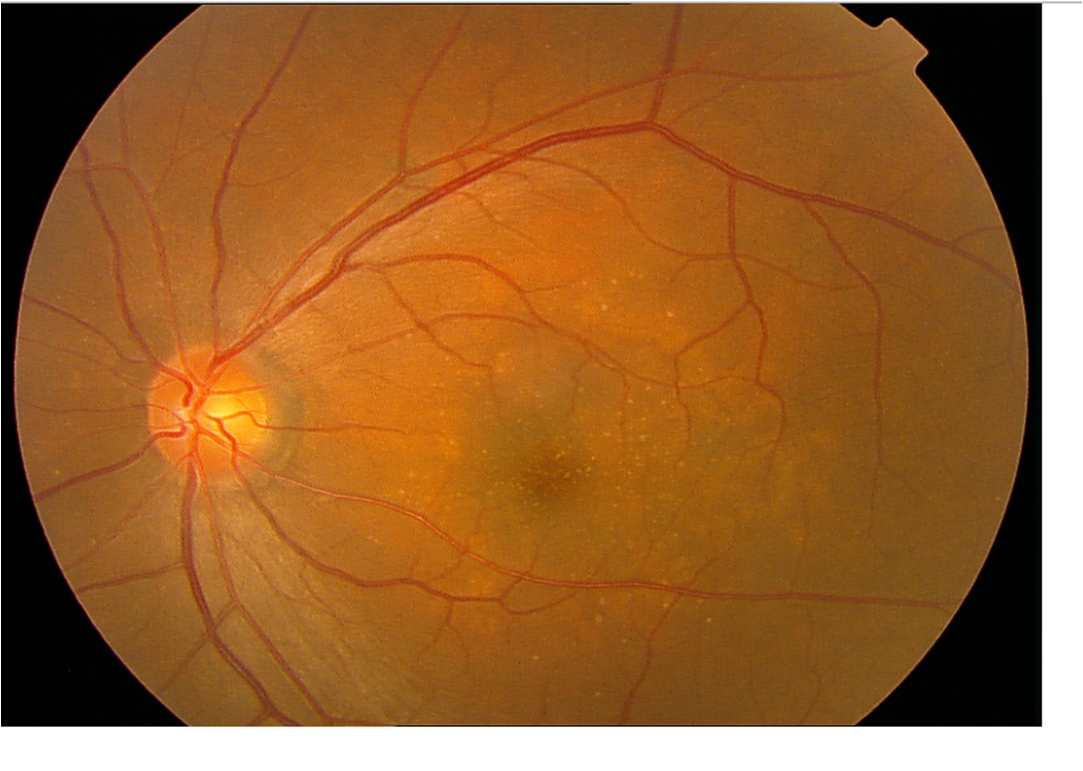 Ангиосклероз сетчатки глаза - что это такое, симптомы и лечение