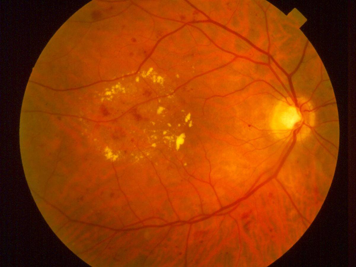 Макулярный отек сетчатки глаза - диагностика, причины, лечение