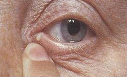 Белые выделения из глаз у взрослых: причины и лечение