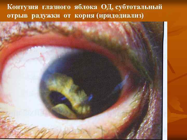Ушиб глаза - степени контузии глазного яблока, симптомы, первая помощь и лечение