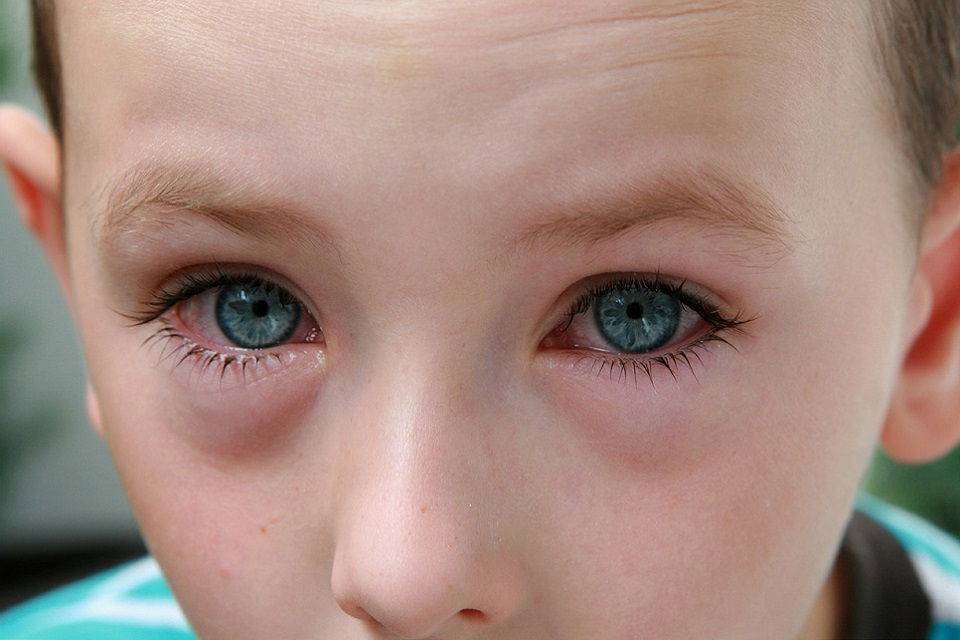 Красные глаза у ребенка при простуде