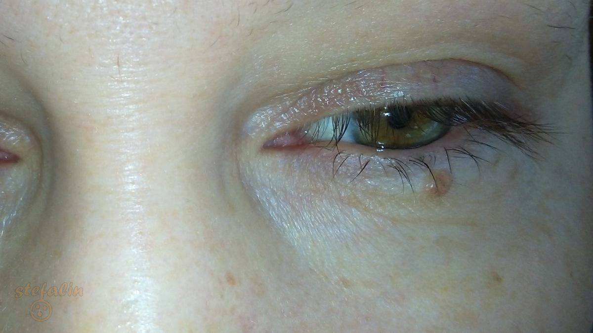 Причины развития птеригиума и операция по удалению нароста на глазу