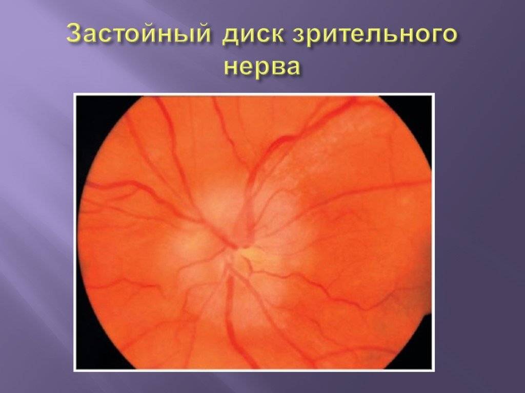 Застойный диск зрительного нерва - следствие повышенного внутричерепного давления. как лечить данное заболевание? каковы его причины?