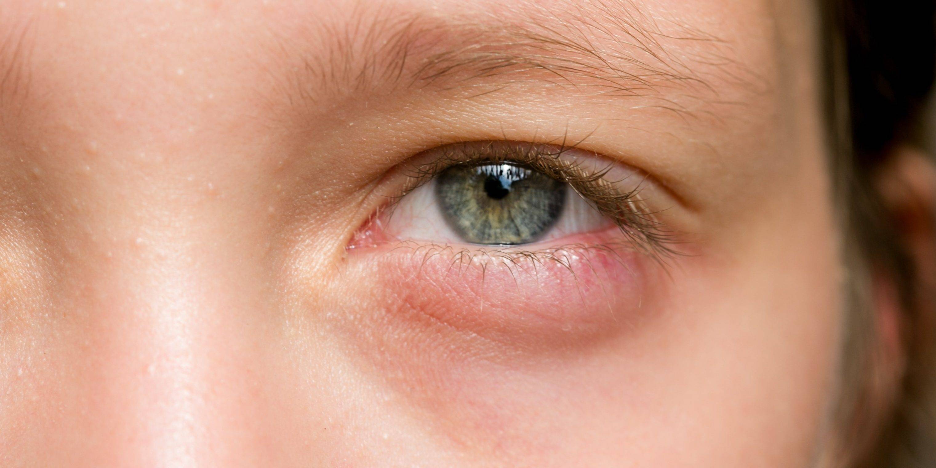 У ребенка опухло верхнее веко глаза: причины, что делать при отеке и покраснении, диагностика и профилактика отечности