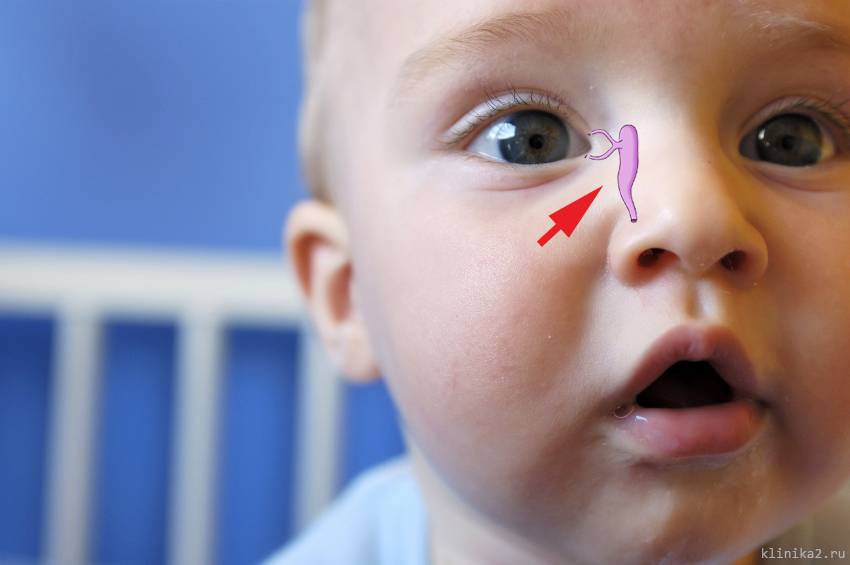 Зондирование носослёзного канала: когда ребёнку нужна помощь