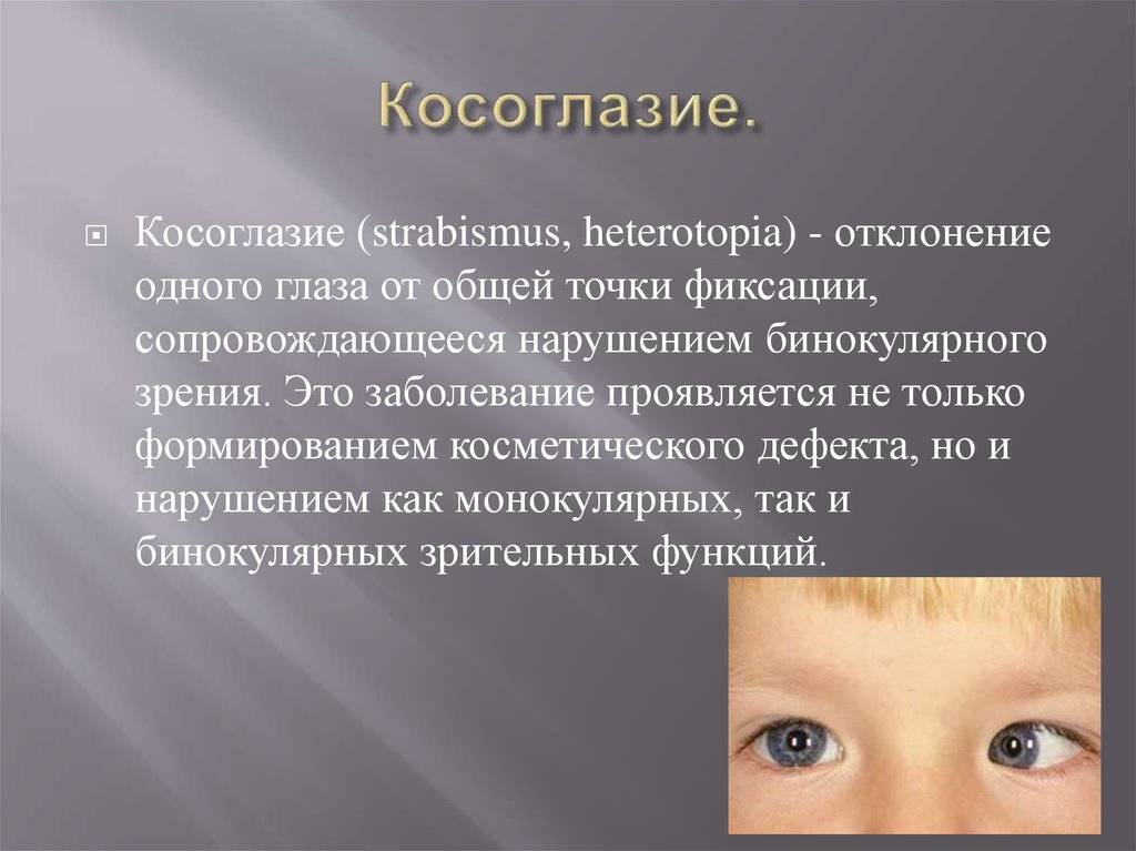Расходящееся косоглазие у взрослых и детей: симптомы, причины, лечение, упражнения, виды страбизма (при поражении глаз, альтернирующее), диагностика, профилактика