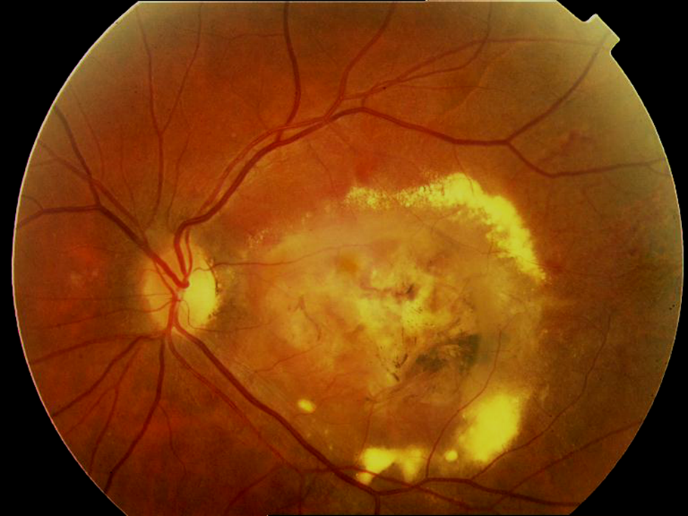 Дегенерация сетчатки глаза: что это такое, симптомы, причины, лечение oculistic.ru
дегенерация сетчатки глаза: что это такое, симптомы, причины, лечение