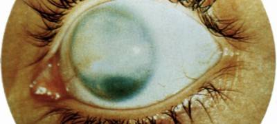 Помутнение роговицы глаза (лейкома, бельмо): не затягивайте визит к офтальмологу!
