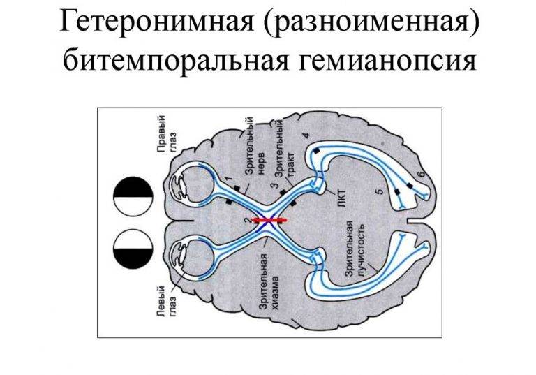 Гемианопсия: симптомы и лечение