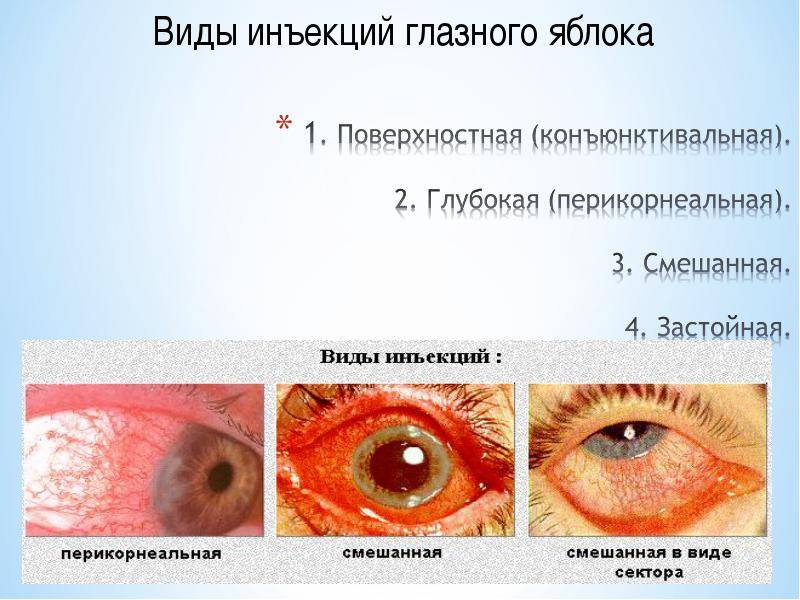 Укол в глаз: как делают, инъекции в глазное яблоко, уколы в висок