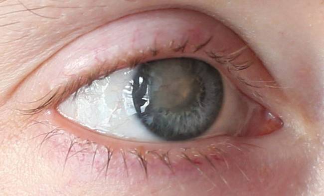 Воспаление роговицы глаза - что это, лечение, последствия