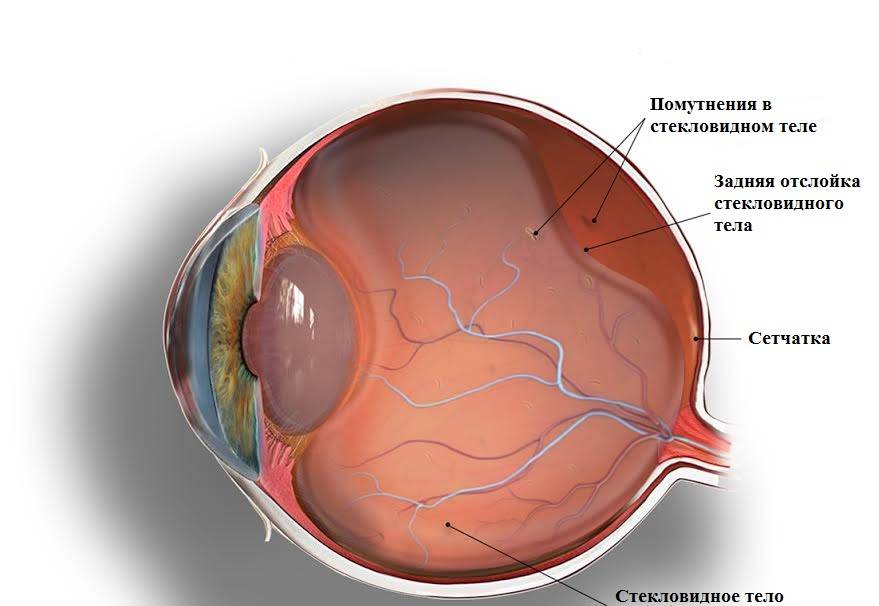 Лечение деструкции стекловидного тела глаза