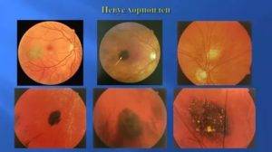 Невус хориоидеи глаза | лечение глаз