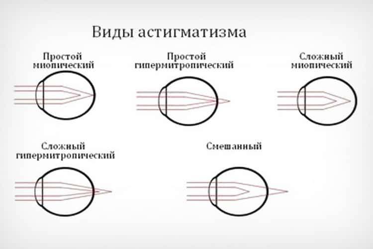 Гиперметропический астигматизм