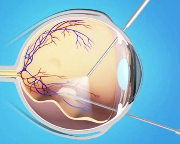 Почему происходит отслоение сетчатки глаза? операция по восстановлению зрения.