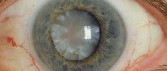 Повторная катаракта после замены хрусталика: причина осложнения после удаления