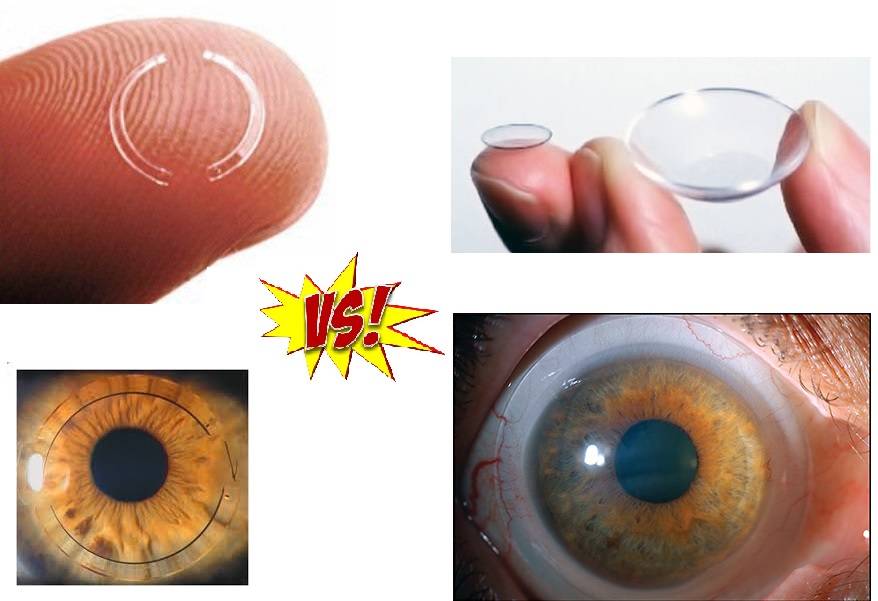 Жесткие контактные линзы (жкл): преимущества и особенности. сайт «московская офтальмология»